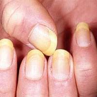 Yellowing nails